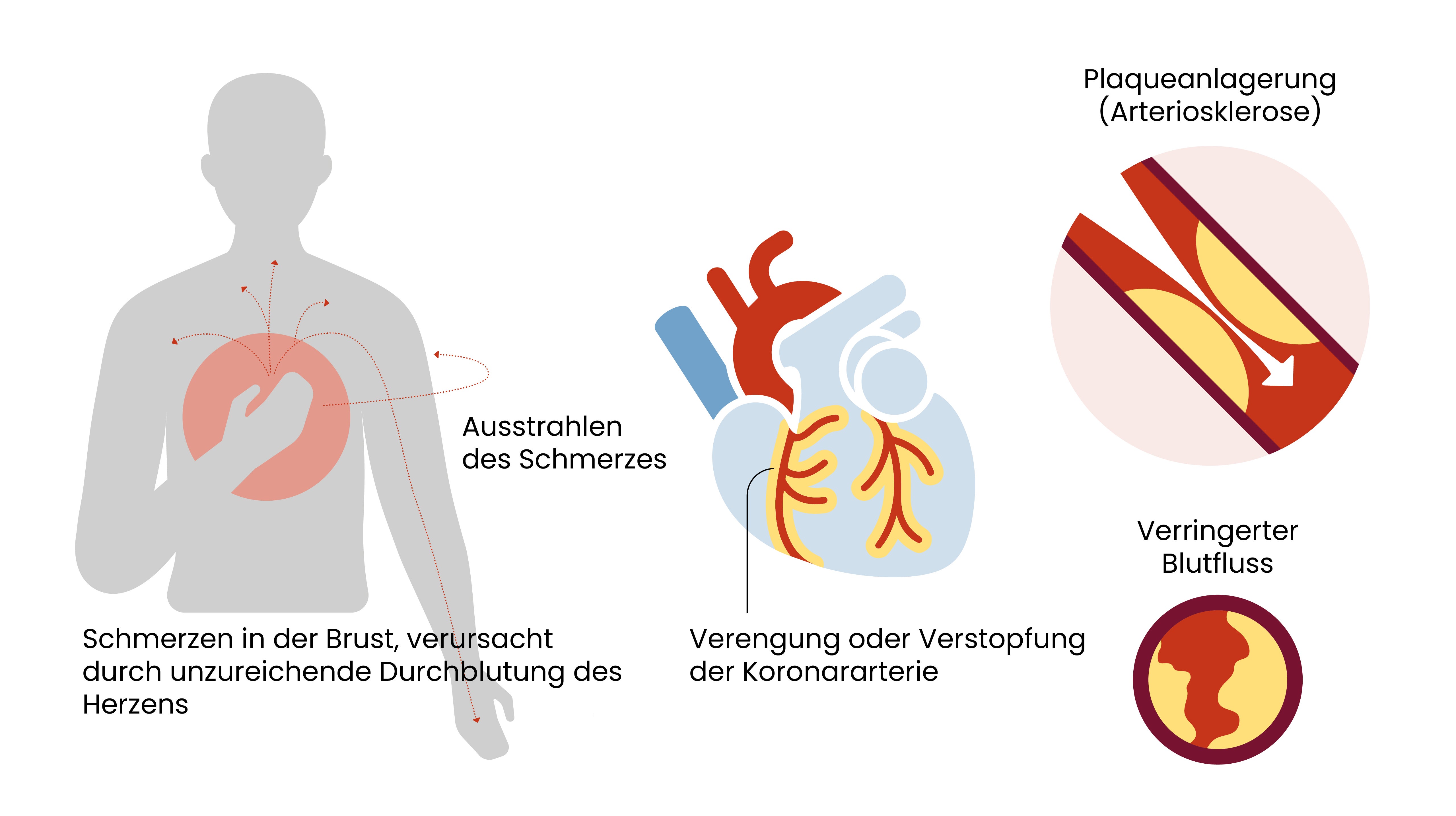 Angina pectoris einfach erklärt