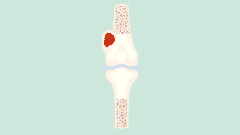 Schema eines Chondrosarkoms