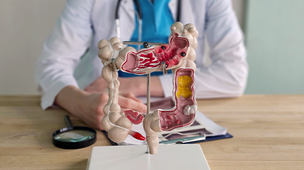 Colitis ulcerosa an einem Modell erklärt von einem Arzt