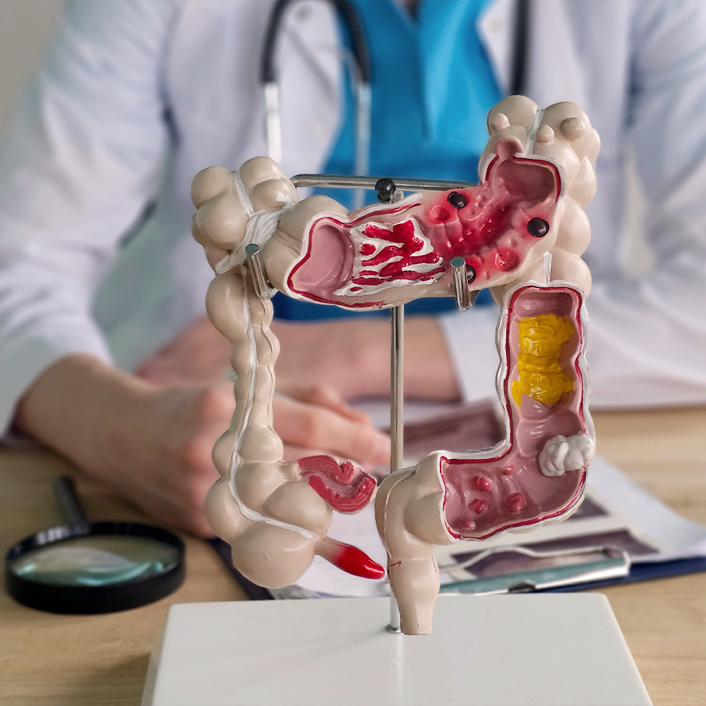 Colitis ulcerosa  Ursachen, Symptome und moderne Therapie | DocMorris