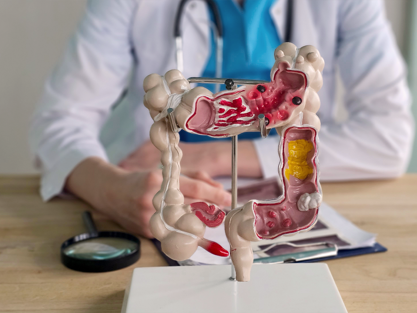 Colitis ulcerosa  Ursachen, Symptome und moderne Therapie | DocMorris