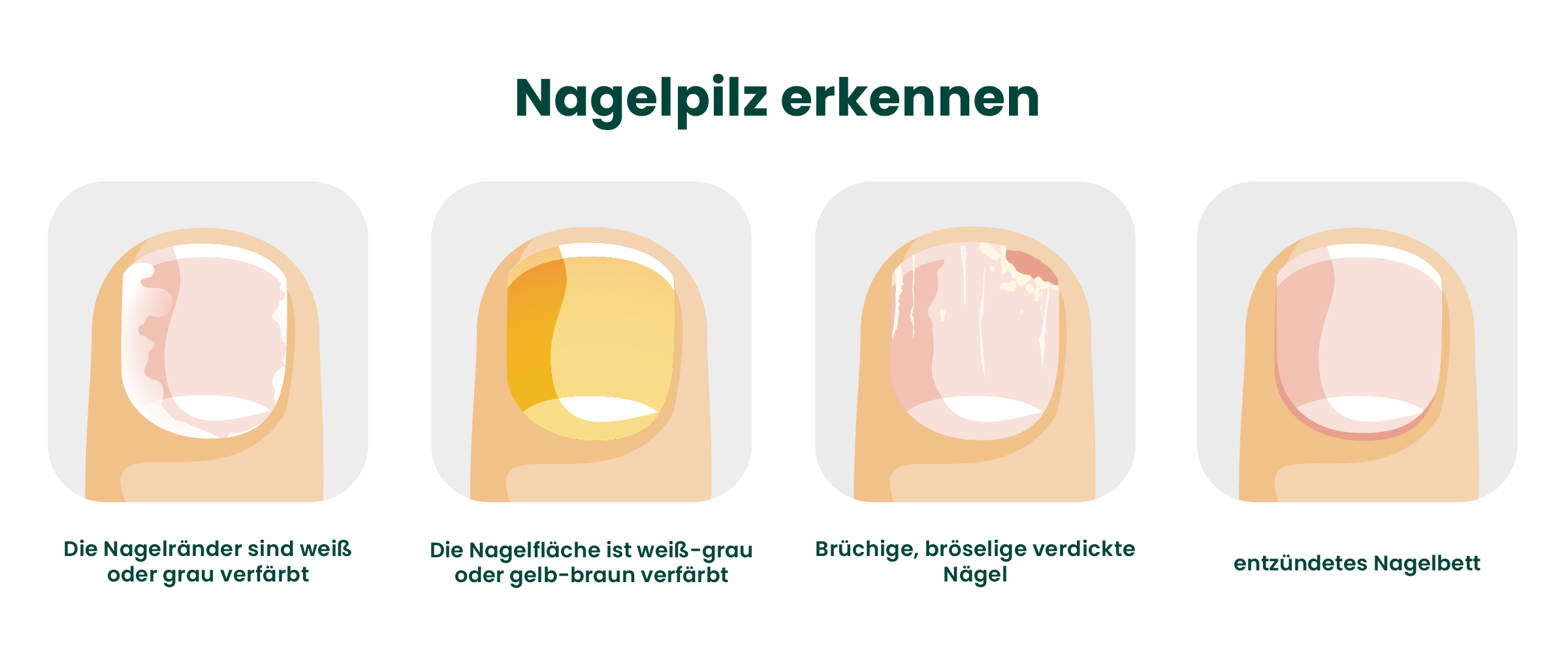 Infografik Nagelpilz erkennen: So sieht Nagelpilz aus