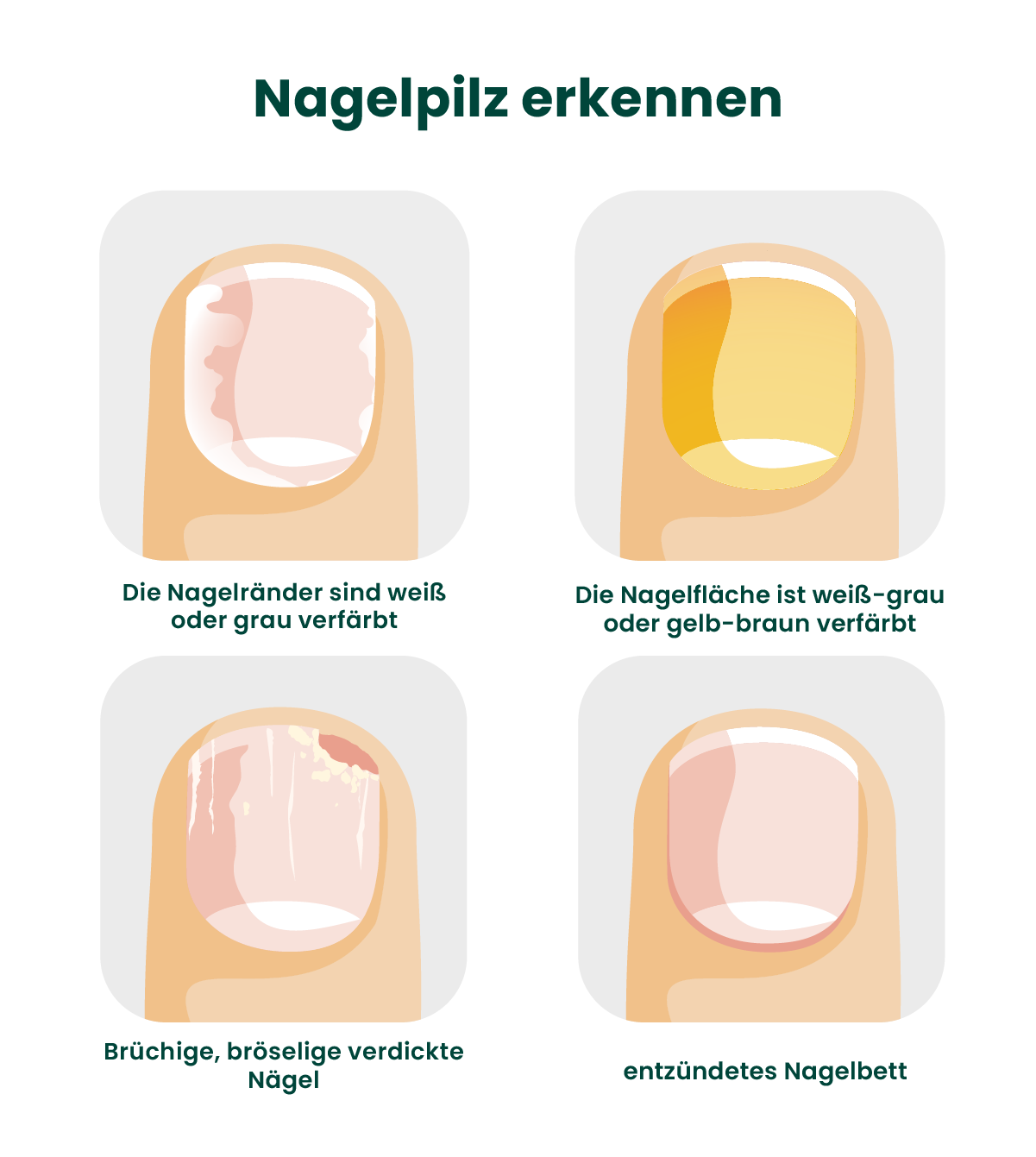 Infografik Nagelpilz erkennen: So sieht Nagelpilz aus