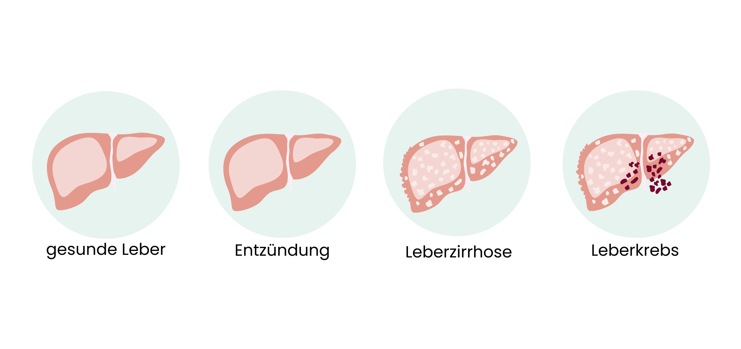 Abbildung zu Lebererkrankungen und Leberkrebs