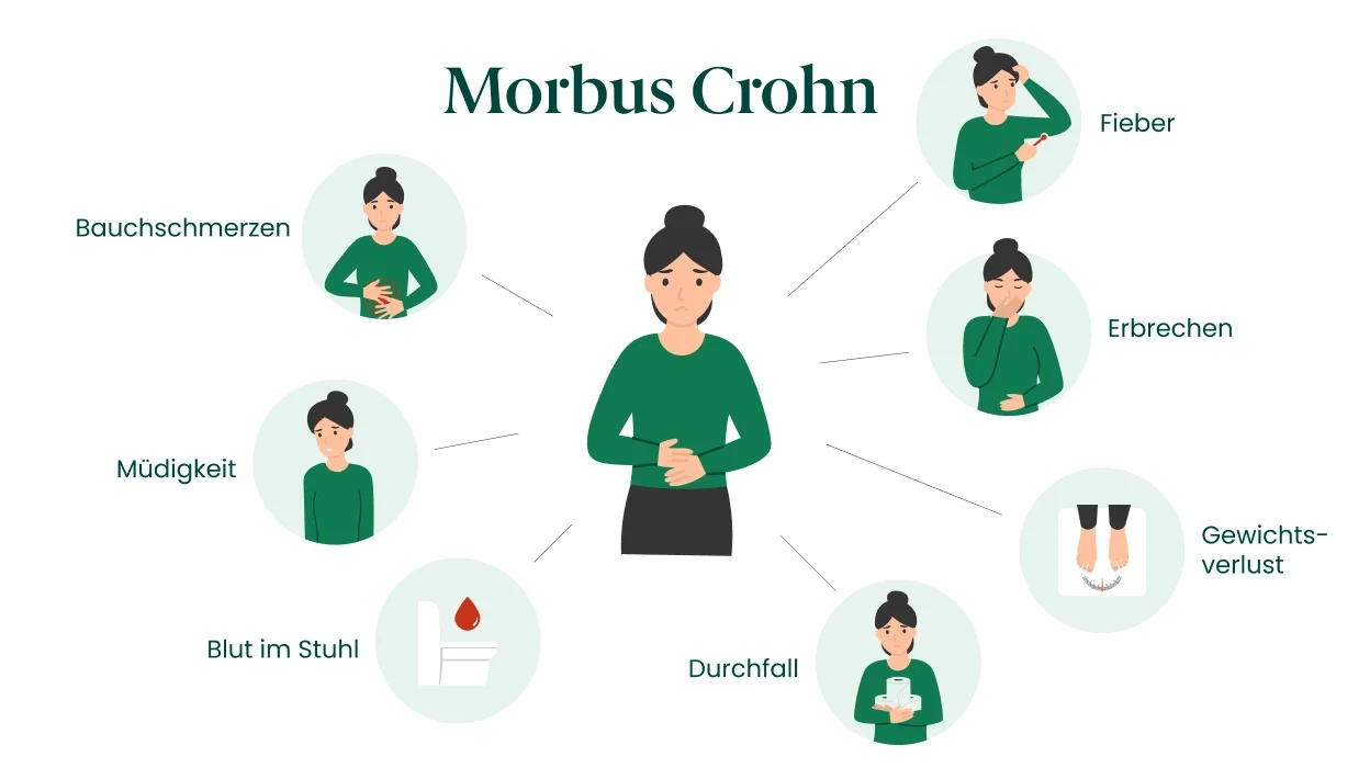 Abbildung zu Symptomen bei Morbus Crohn