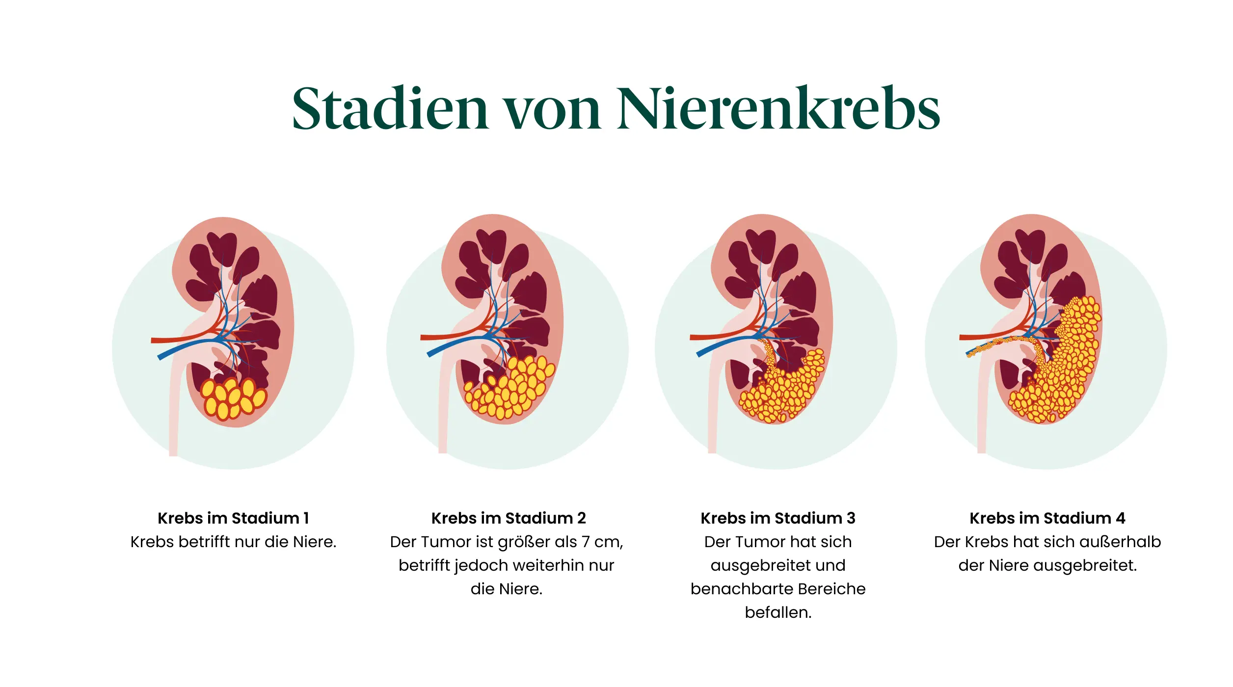 Abbildung zu Stadien von Nierenkrebs