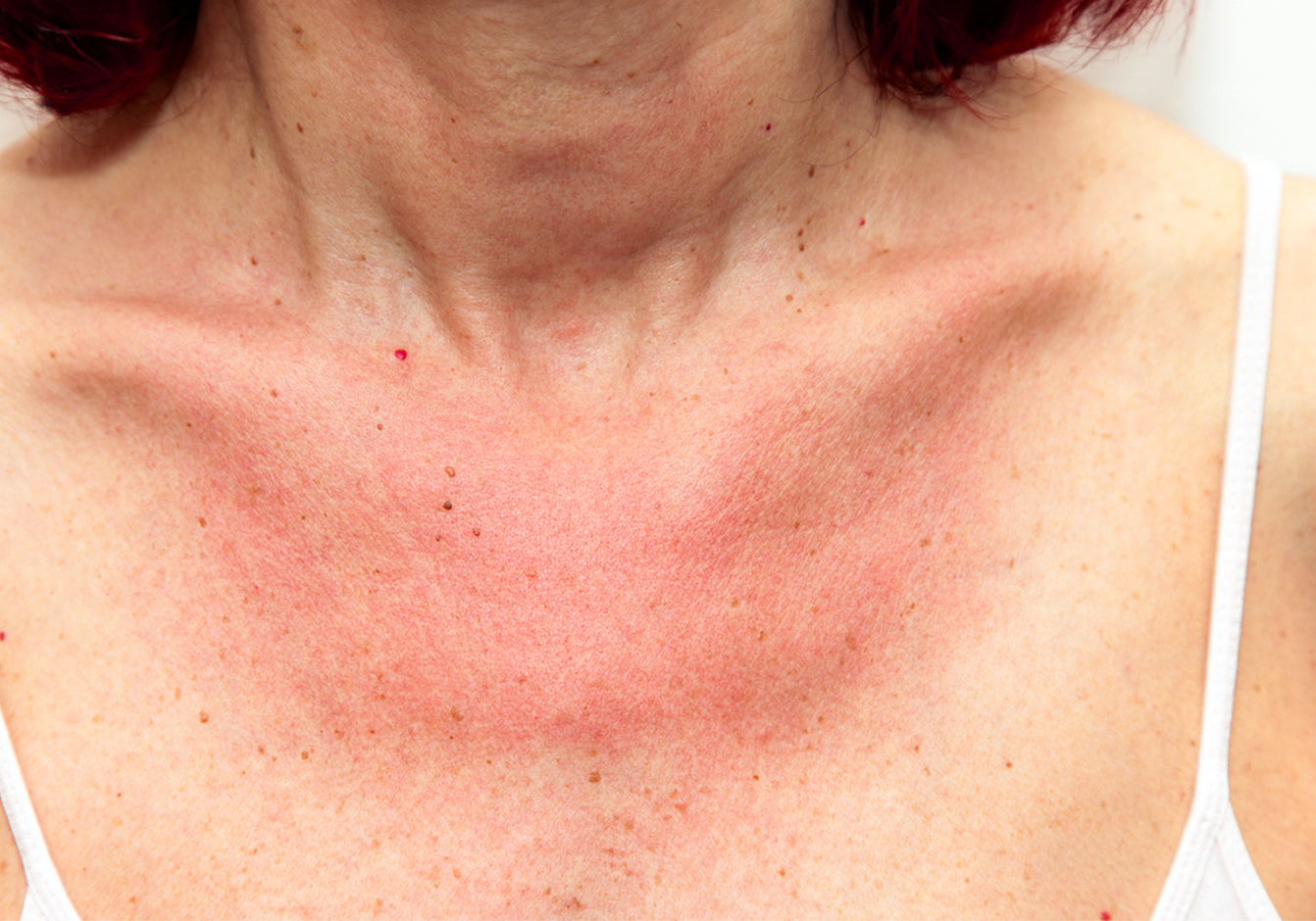 Reisedermatose