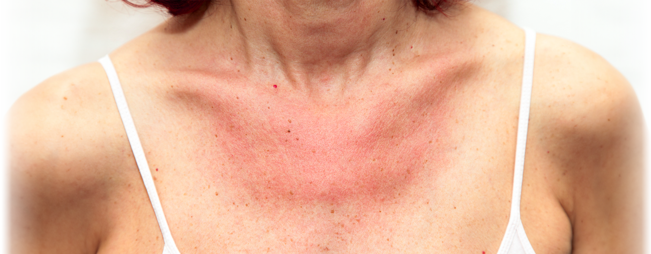 Reisedermatose
