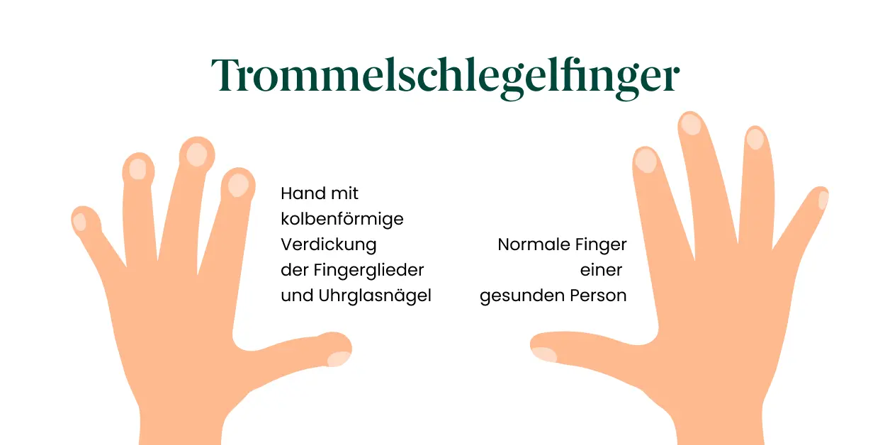 Trommelschlegelfinger als Symptom bei Lungenkrebs